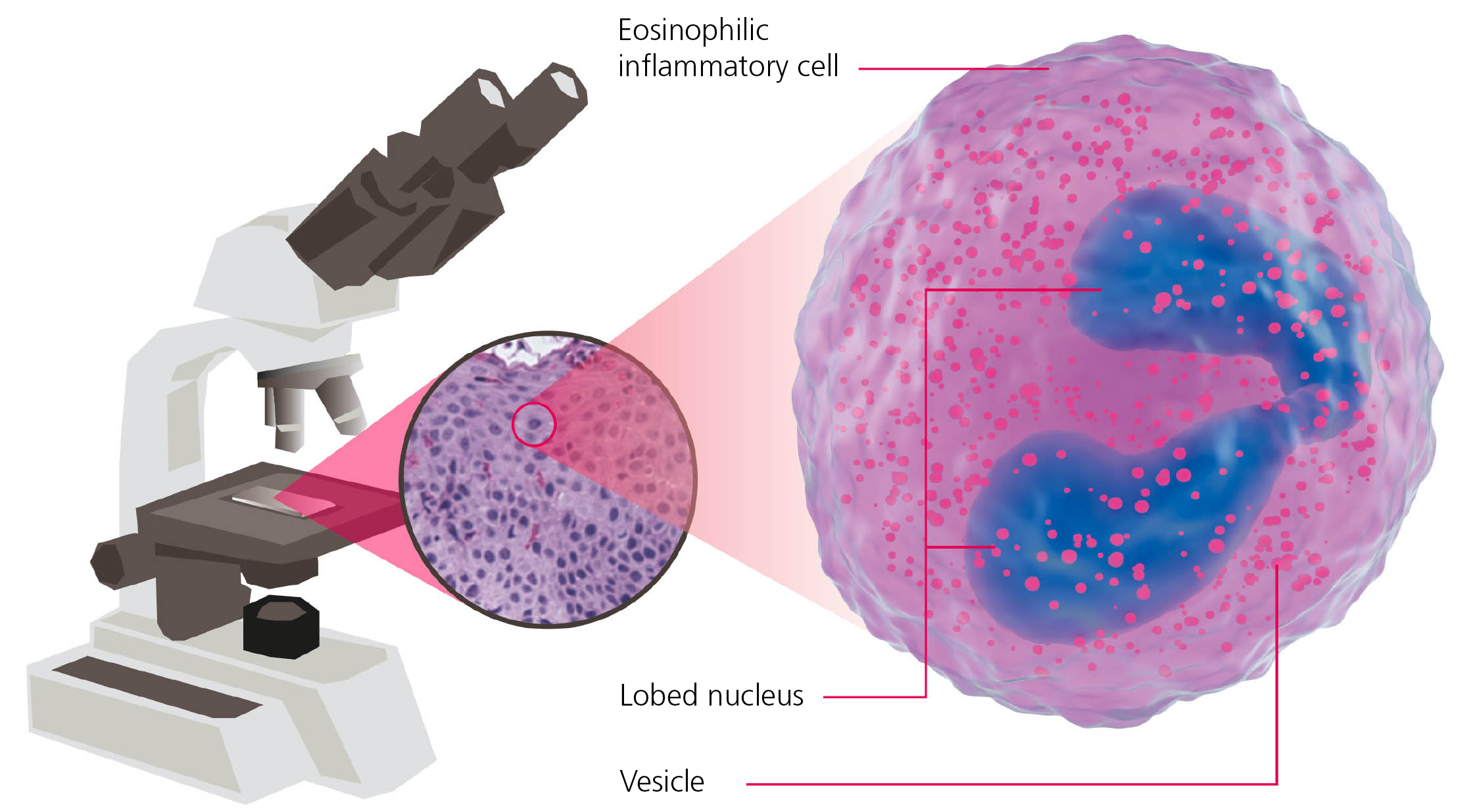 Eosinophilic inflammatory cell